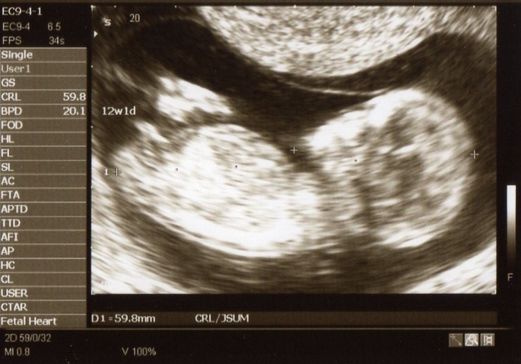 妊娠12週のエコー写真。この頃にはすでに赤ちゃんの姿が確認できるまで成長している。これ以降は中期中絶となり、母体にかなりの負担を強いる。