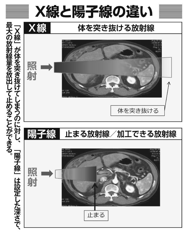 陽子線は病巣をピンポイントで攻撃できるため、正常な組織への影響が最小限に抑えられる（写真／新日本科学提供）