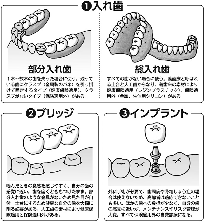 歯を失ったときの選択肢