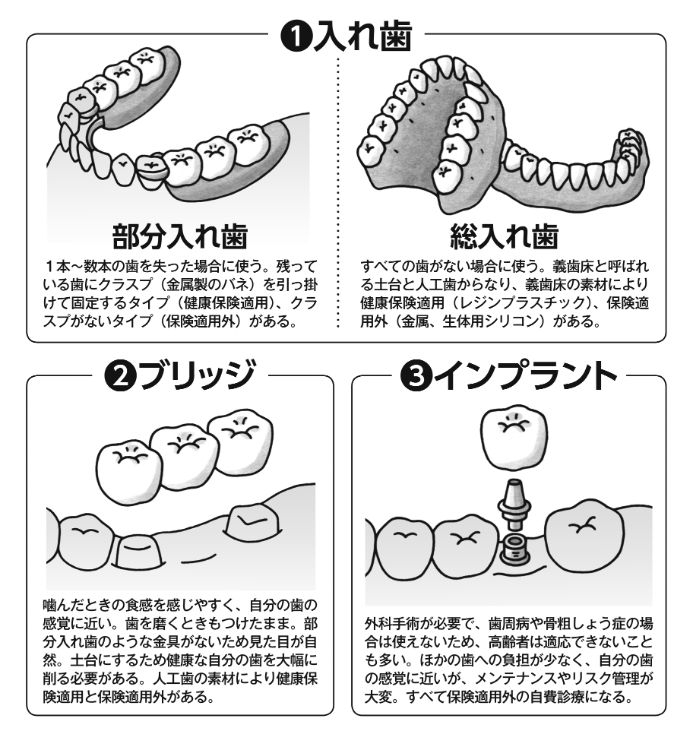 歯を失ったときの3つの選択肢。義歯にもいろいろな種類がある