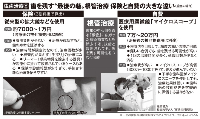 根管治療、保険と自費の違いとは
