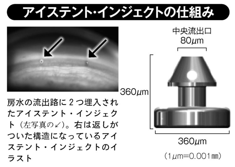 アイステント・インジェクトの仕組み