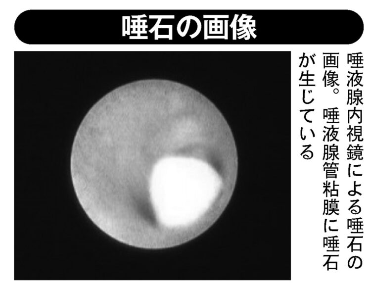 唾液腺内視鏡による唾石の画像。唾液腺管粘膜に唾石が生じている