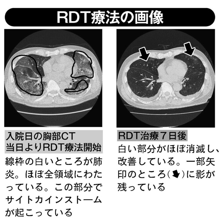 RFT療法の画像
