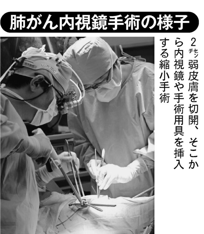 肺がん内視鏡手術の様子