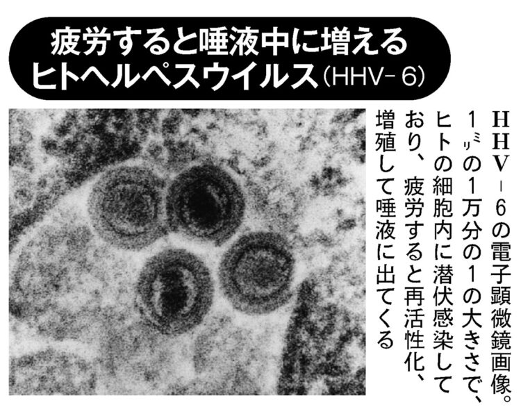 疲労すると唾液中に増えるヒトヘルペスウイルス（HHV-6）
