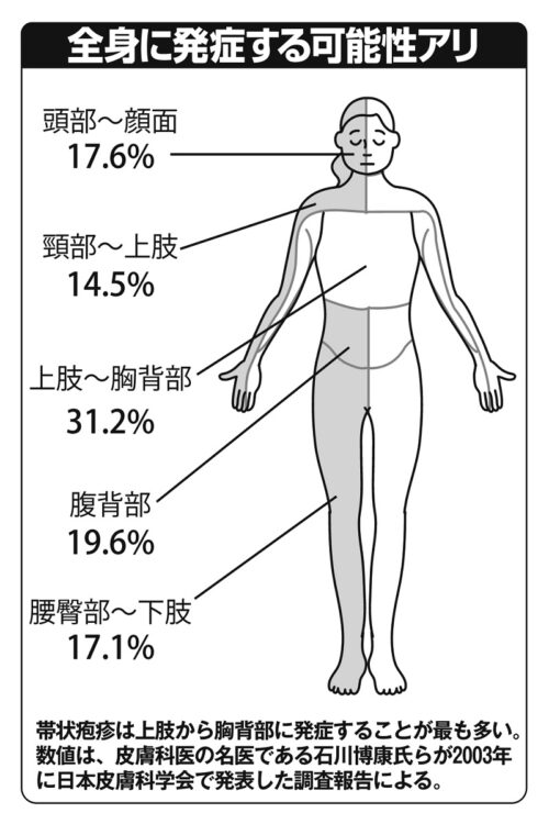 コロナ禍のストレスで増える帯状疱疹 後遺症が10年続くことも Newsポストセブン Part 3