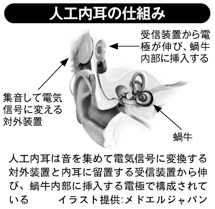 人工内耳の仕組み