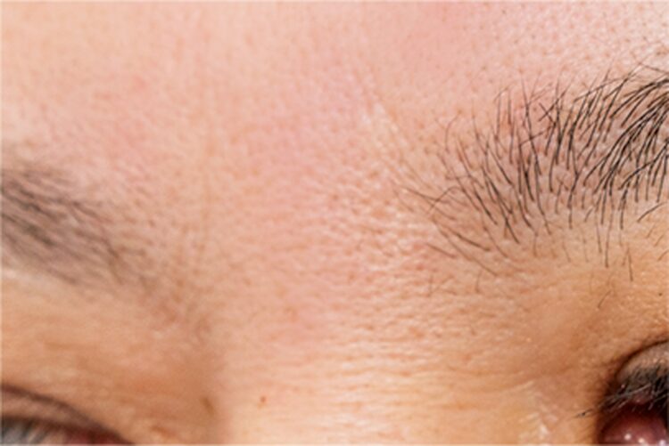 ボトックスのアフター