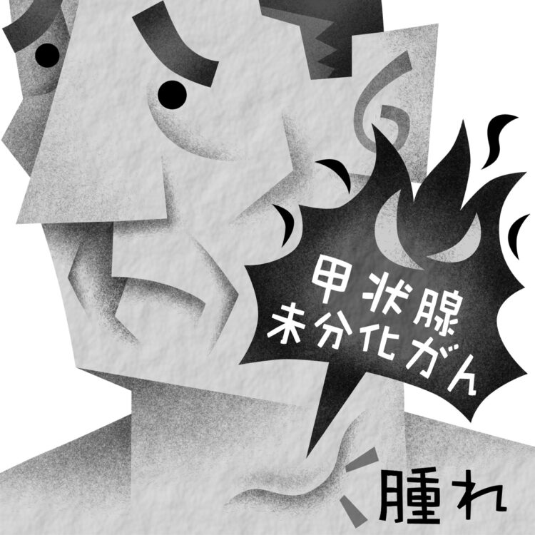 甲状腺がんの悪性「未分化がん」の特徴は？（イラスト／いかわ やすとし）