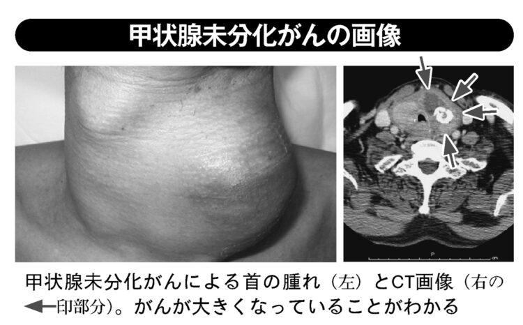 甲状腺未分化がんの画像