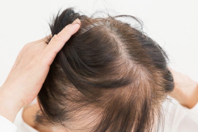 女性の薄毛の原因はホルモンバランスの影響や、髪形などさまざま（写真はイメージ）