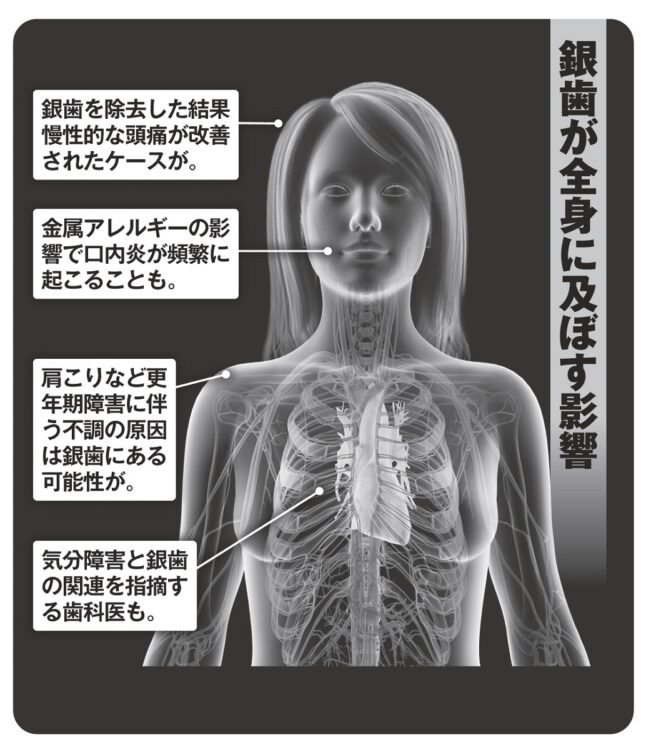 銀歯が全身に及ぼす影響