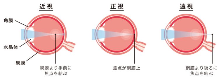 近視・遠視のメカニズム