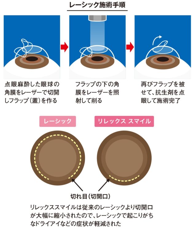 レーシックの施術手順、レーシックとリレックススマイルの違い