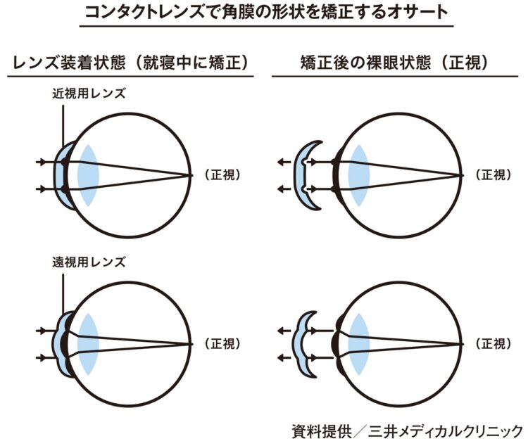 コンタクトレンズで角膜の形状を矯正するオサート