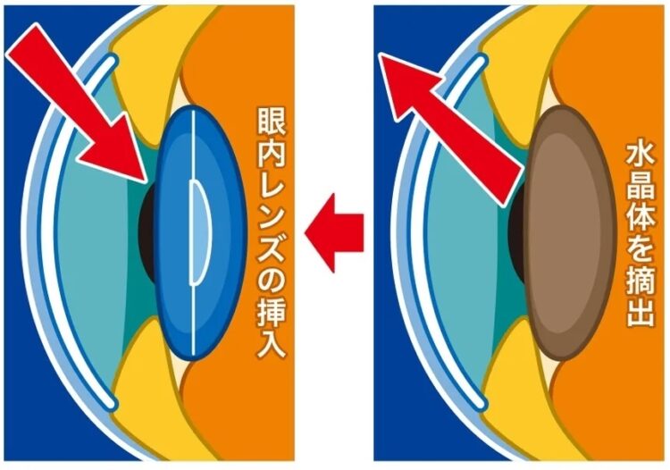 目のピント調整機能を持つ水晶体を、人工のレンズに置き換える「多焦点眼内レンズ」