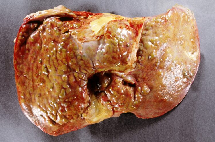 肝硬変を起こした肝臓。脂肪肝が原因で肝硬変になり肝機能が充分に働かなくなるケースもある（写真／アフロ）