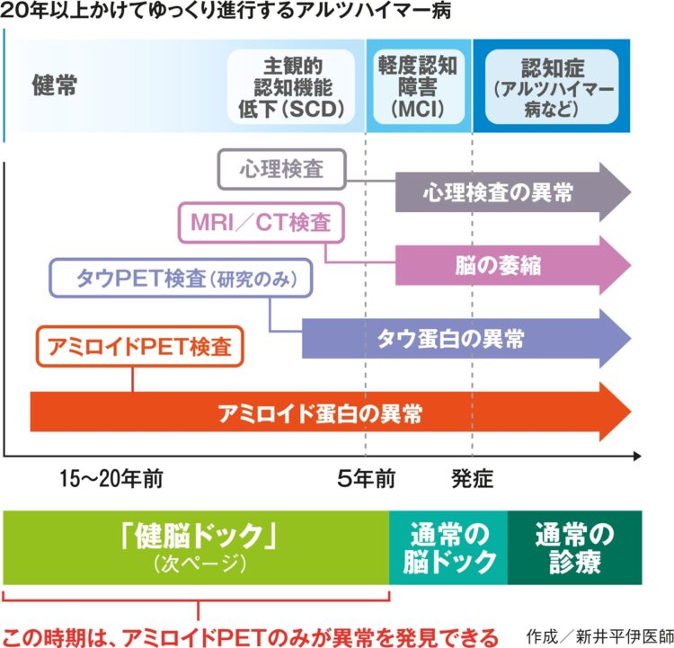 アルツハイマー病が進行するまで