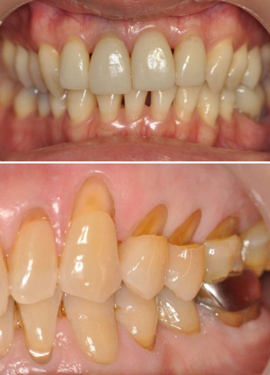 歯茎がやせてきた状態。加齢以上に歯磨きのしすぎが原因（上）。歯根の象牙質の部分が歯磨きと研磨剤により削れ、楔状欠損を起こしている（下）（写真／山田歯科医院提供）