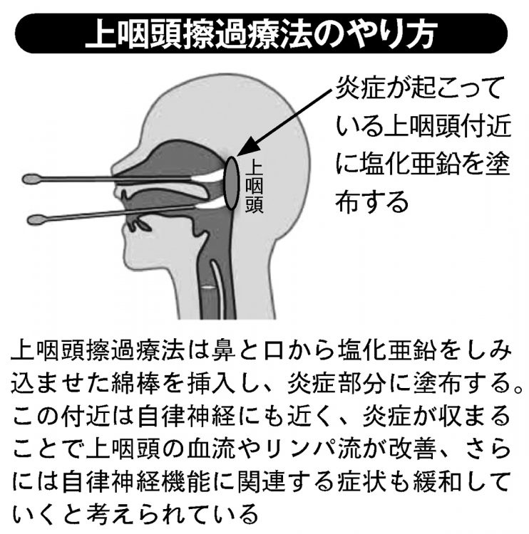 上咽頭擦過療法のやり方
