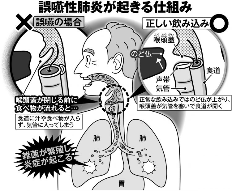 誤嚥性肺炎が起きる仕組み