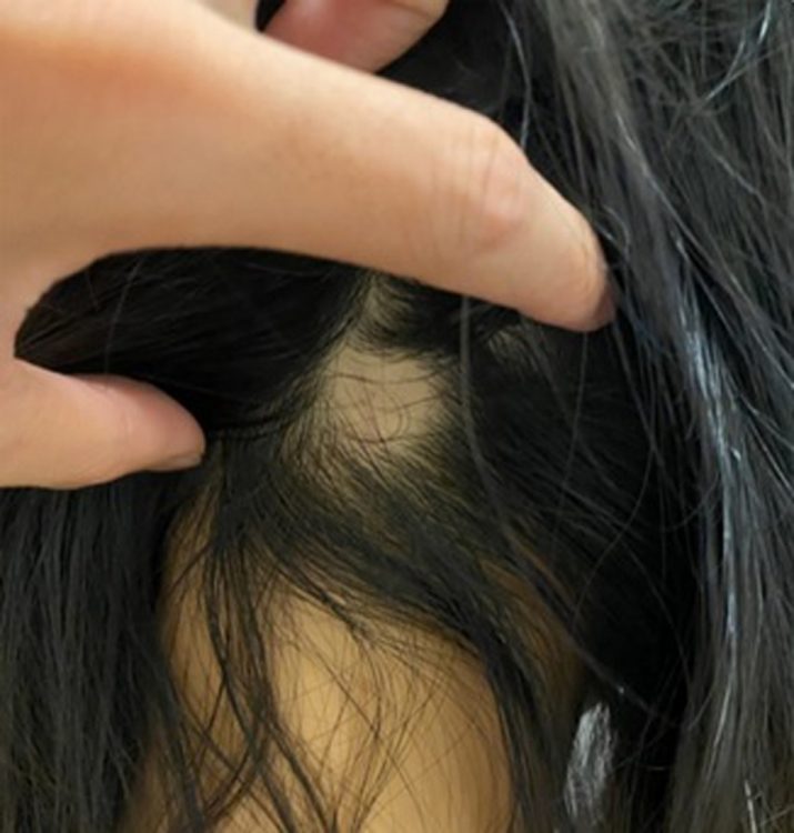 【写真】20代女性「ワクチン接種2日後から大量の抜け毛」体験談を検証する｜NEWSポストセブン Part 2