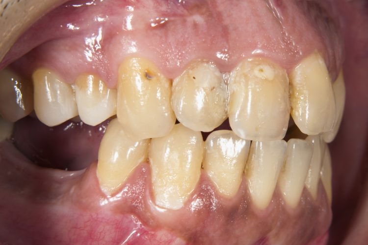 歯周病は日本人が歯を失う原因の第1位（写真／Getty Images）