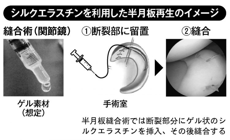 シルクエラスチンを利用した半月板再生のイメージ