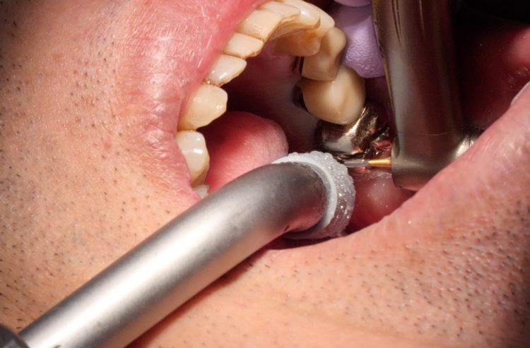 歯周病とコロナの関係に新たなリスクの指摘が