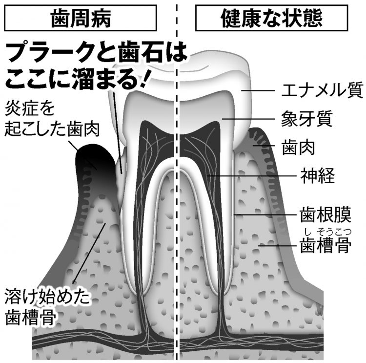 歯周病と健康な状態の比較