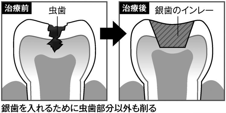 銀歯を入れるために虫歯部分以外も削る