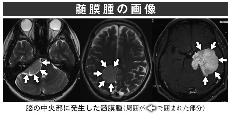 髄膜腫の画像