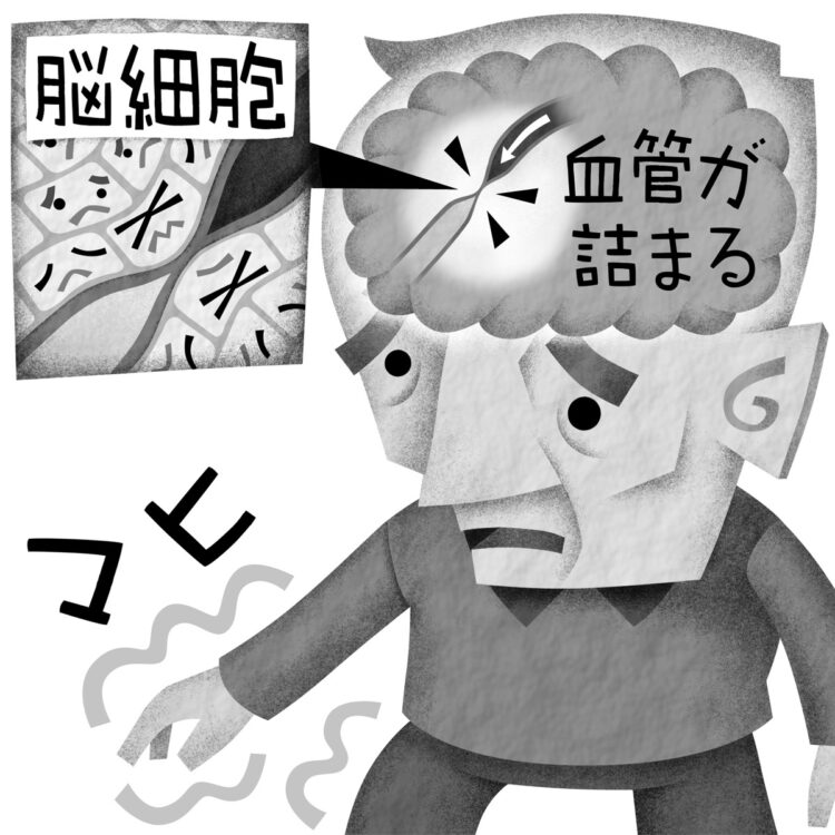 「骨髄間質幹細胞」治療は脳梗塞マヒをどこまで改善する？