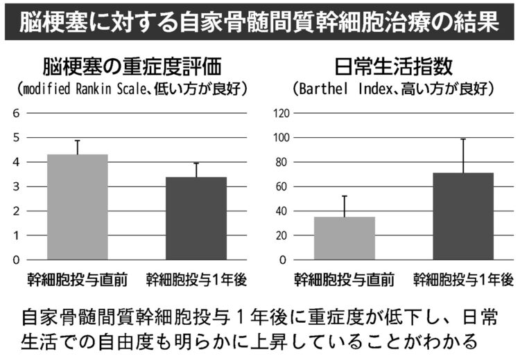 脳梗塞に対する自家骨髄間質幹細胞治療の結果