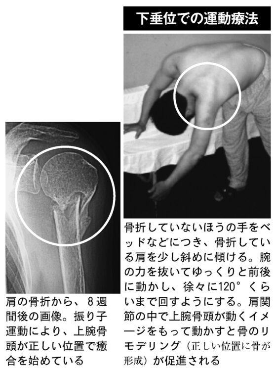 下垂位での運動療法