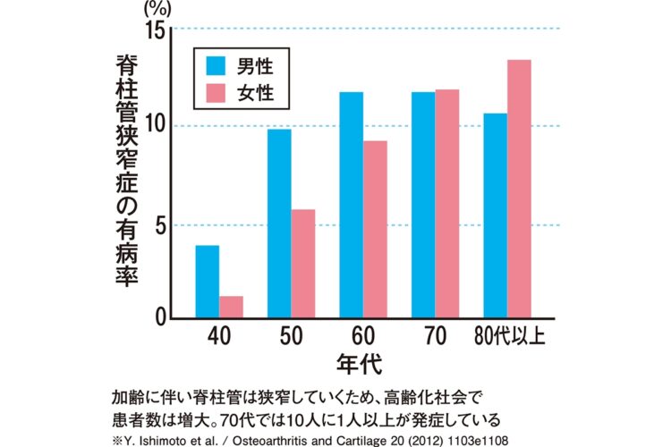 加齢に伴い脊柱管は狭窄していくため、高齢化社会で患者数は増大。70代では10人に1人以上が発症している