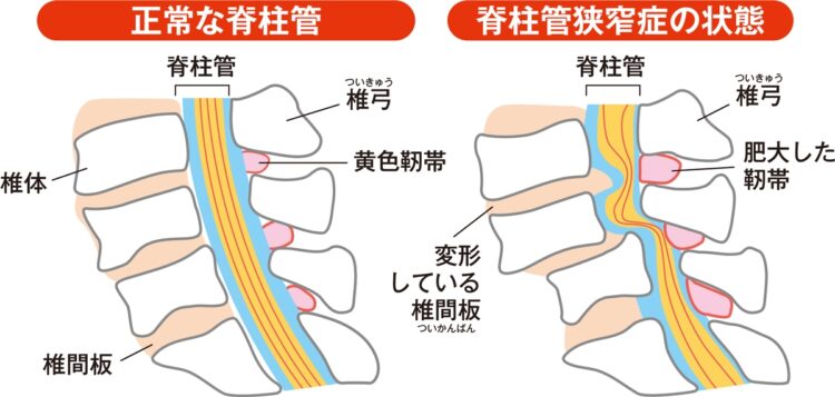正常な脊柱管と脊柱管狭窄症の状態