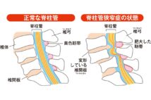 正常な脊柱管と脊柱管狭窄症の状態
