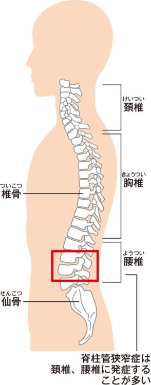 ￥ 脊柱管狭窄症とは？