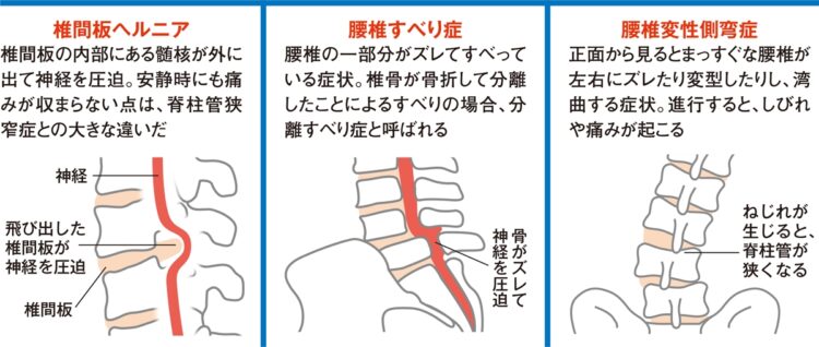 脊柱管狭窄症と椎間板ヘルニアなどとの違い