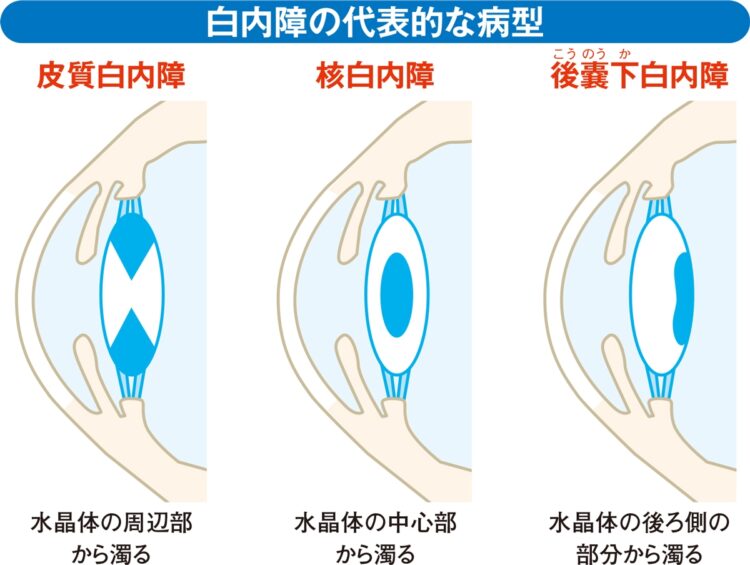 白内障の代表的な病型