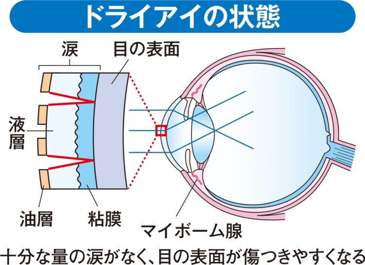 ドライアイの状態