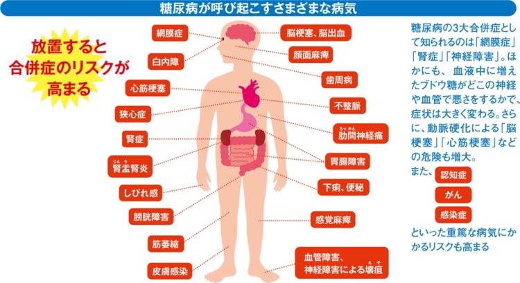 糖尿病が呼び起こすさまざまな病気