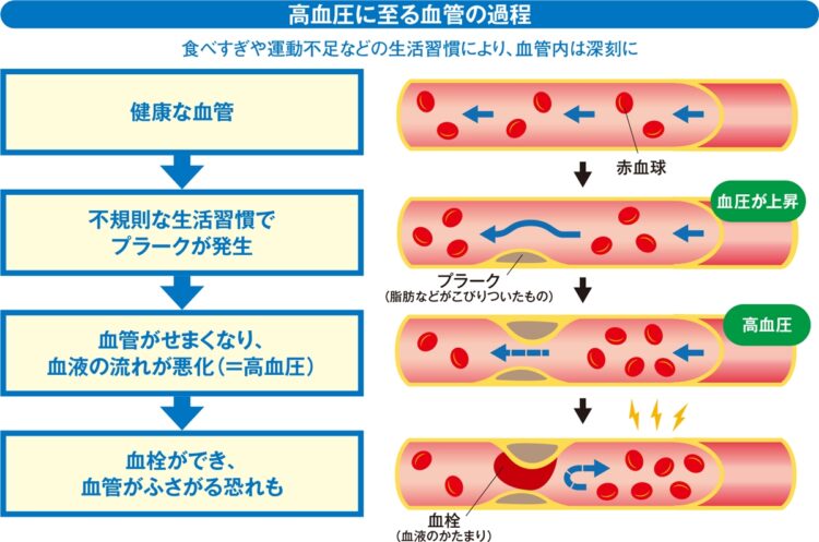 高血圧に至る血管の過程