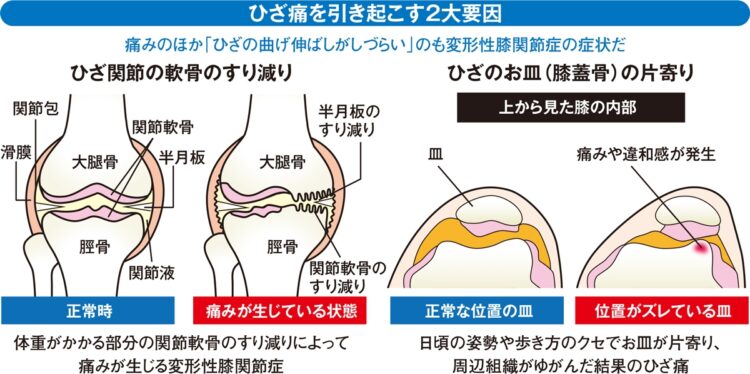 ひざ痛を引き起こす2大要因