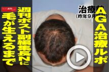 【動画】AGA治療ルポ　週刊ポスト副編集長Nに毛が生えるまで