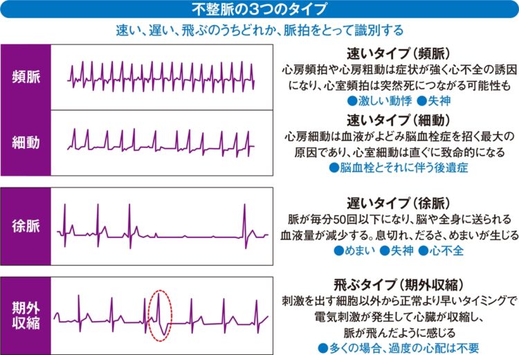 不整脈3つのタイプ