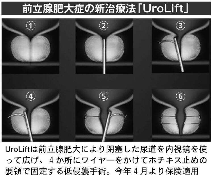 前立腺肥大症の新治療「UroLift」