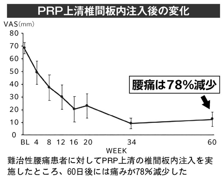 PRP上清椎間板内注入後の変化